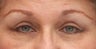 Eyelid Surgery