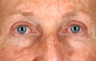 Eyelid Surgery