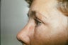 upper and lower eyelid blepharoplasty