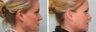 Upper blepharoplasty