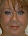 Laser Resurfacing, Upper Blepharoplasty and Signature Facelift