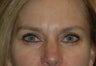 Eyelid Surgery