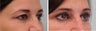 Upper Blepharoplasty