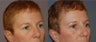 Upper blepharoplasty and brawlift