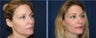 Eyelid surgery 