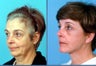 She underwent upper blepharoplasty or upper eyelid surgery and brawlift procedures.  