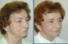 Patient will be haveing Blepharoplasty along with upper and lower eyelid lift.