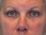 Blepharoplasty