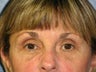 Blepharoplasty