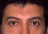 Blepharoplasty
