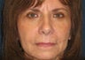 Eyelid Surgery