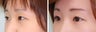 Double Eyelid Surgery - Suture Technique