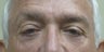 Eyelid Surgery