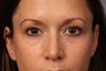 34 yr old Lower Eyelid Surgery