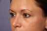 34 yr old lower eyelid surgery