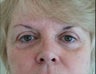 Eyelid Surgery