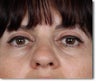 Eyelid Surgery