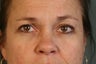 Lower blepharoplasty to improve eye bags