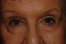 Eyelid Surgery