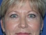 Eyelid Surgery