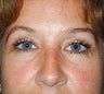 Eyelid Surgery