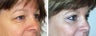 Blepharoplasty