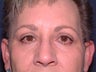 Upper blepharoplasty / Lower blepharoplasty