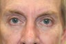 Upper blepharoplasty / Lower blepharoplasty