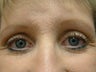 Blepharoplaty (lower eyelid fat/skin removed)