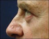Eyelid Surgery