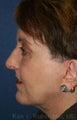 Blepharoplasty, Browlift, Liposuction, Thermage