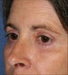 Upper & Lower Blepharoplasty