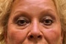 Eyelid Surgery