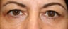 Eyelid Surgery