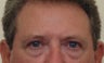 Eyelid Surgery