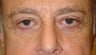Eyelid Surgery