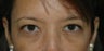 Eyelid Surgery