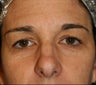 Blepharoplasty