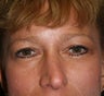 Blepharoplasty, Rhinoplasty and Brow Lift