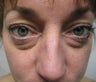 Eyelid Surgery