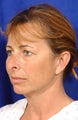 Eyelid Surgery