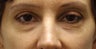 Fat Transfer to Lower Eyelids
