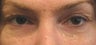 Upper Blepharoplasty 