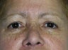 Eyelid Surgery