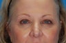 Upper blepharoplasty, lower blepharoplasty, and revision rhinoplasty