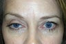 Ptosis Repair and Blepharoplasty