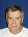Upper and Lower Blepharoplasty