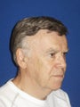 Upper and Lower Blepharoplasty