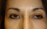 Upper Lid ptosis repair