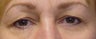 Upper Blepharoplasty